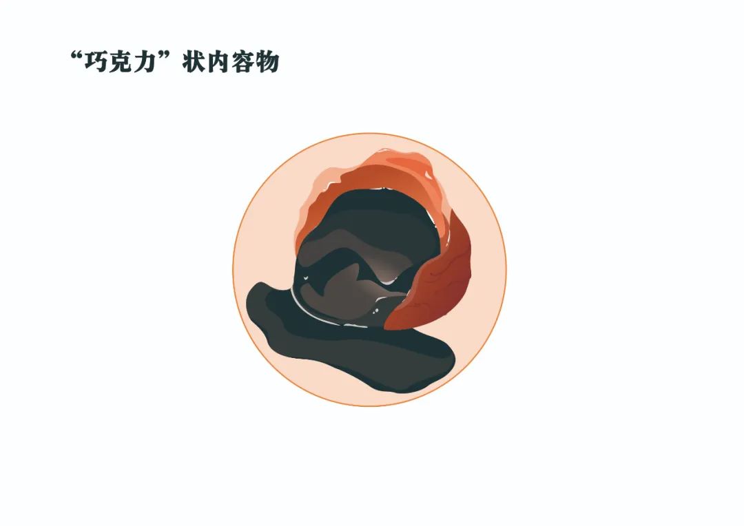 宫颈息肉和巧克力囊肿能一起做吗,子宫囊肿巧克力囊肿中药治疗