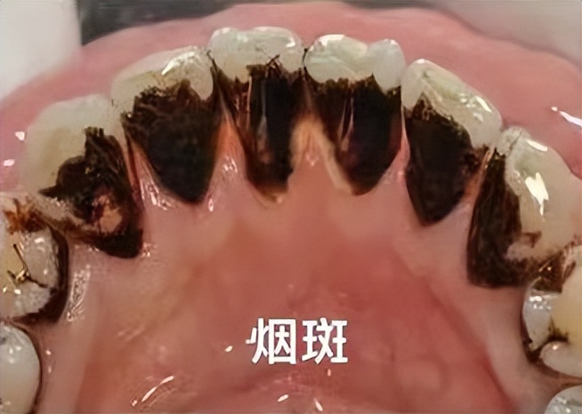 洗牙牙缝变大的原因和解决方法,牙缝特别小怎么洗牙