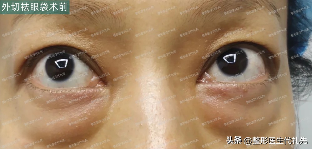 眼袋有明显的脂肪,眼袋脂肪去了显年轻