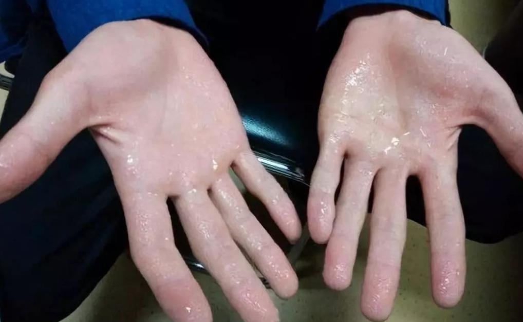 夏季爱出汗什么症状,夏天爱出汗的人说明什么