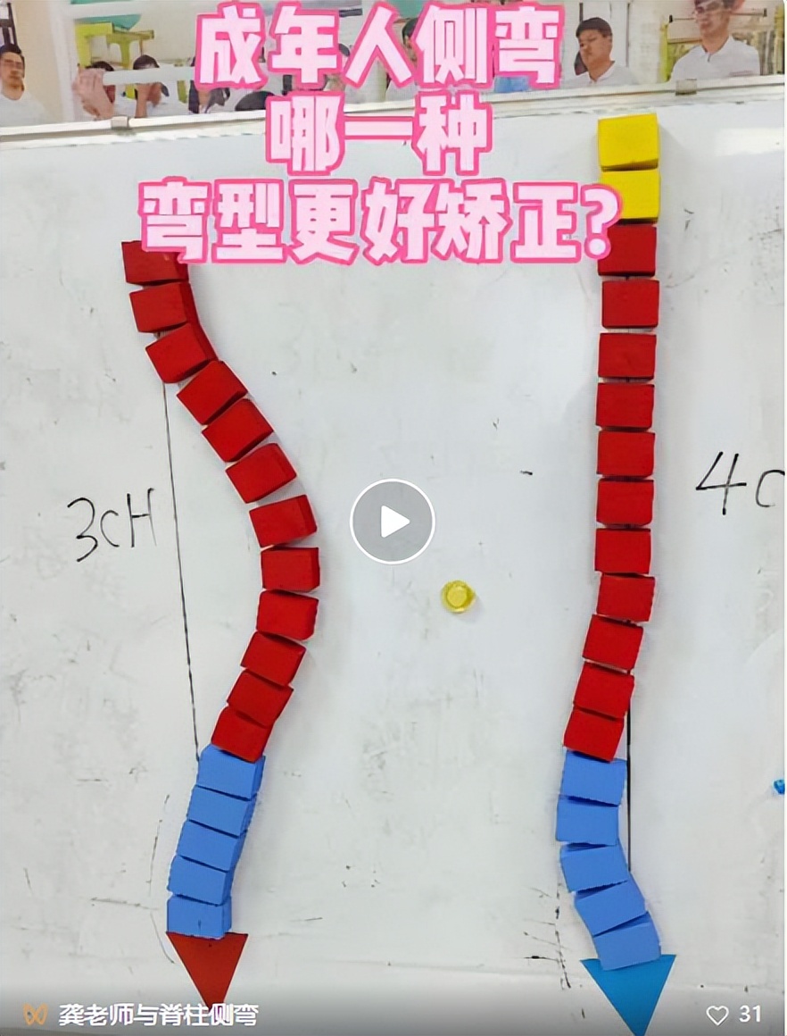 成人脊柱侧弯往哪弯,成年人脊柱侧弯怎么矫正