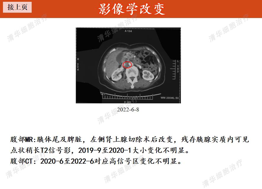 胰腺癌有突破10年的吗,一旦确诊胰腺癌还能活多久