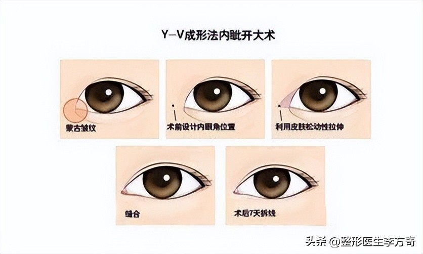 整形医院说双眼皮有几种技术,整形医生如何进行手术