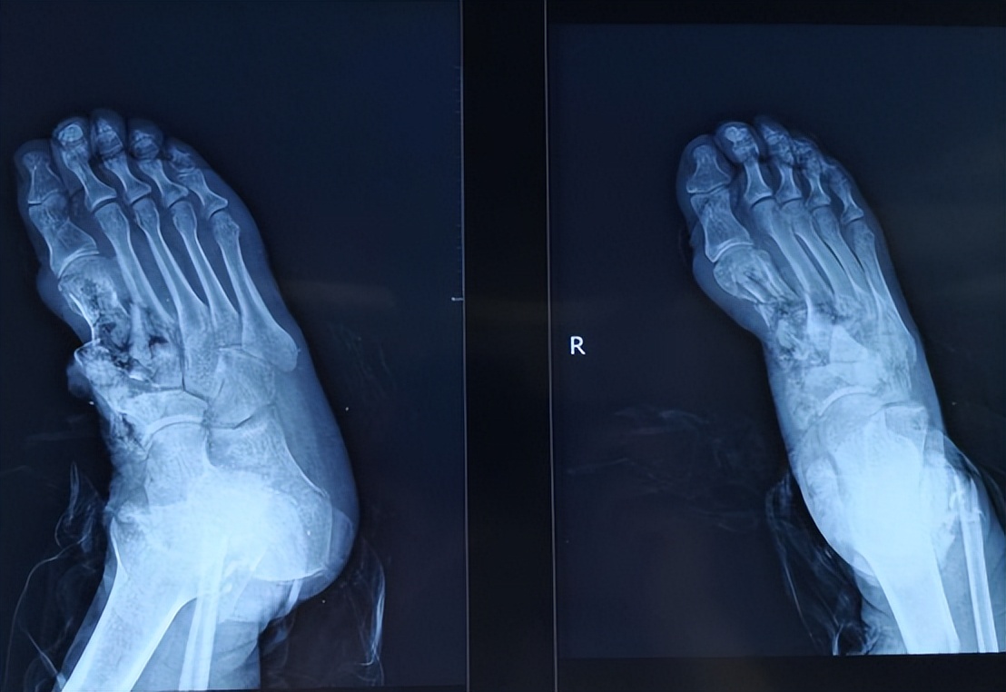 烧伤患者创面处理,烧伤创面处理的原则主要是