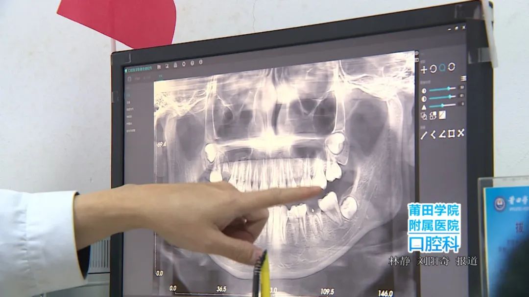 莆田学院附属医院口腔科拔智齿,美丽健康从牙齿开始