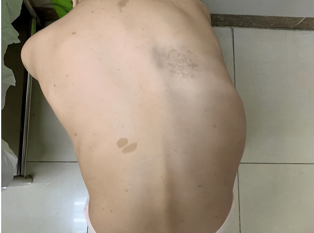 河南22岁女孩体内上千瘤子,22岁女孩体内有1000多个瘤子后续