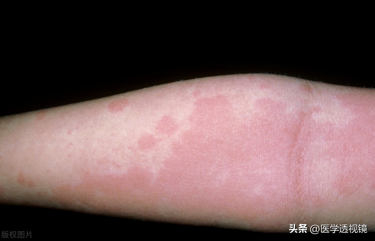 常吃东西过敏,哪些食物易引起食物过敏