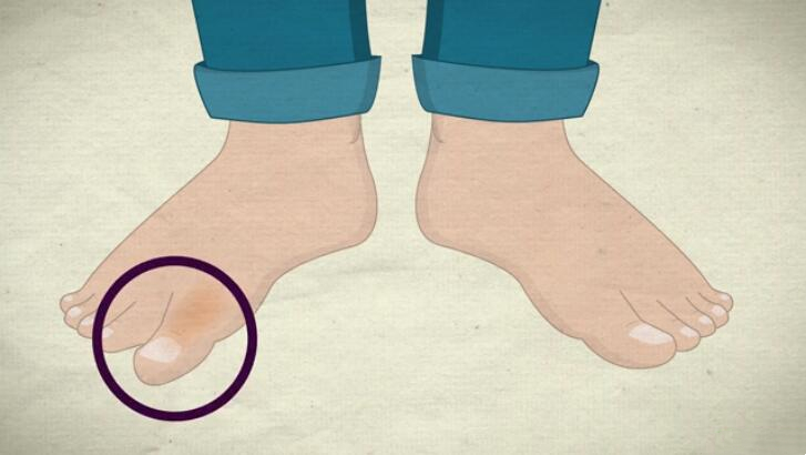 脚趾骨折断端稍分离移位,判断脚趾是骨折还是损伤的方法