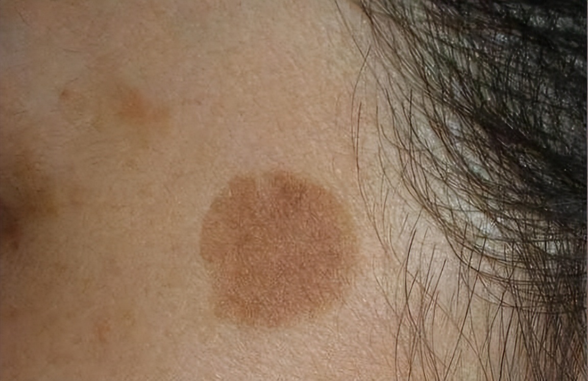 为什么有些人老年斑“密密麻麻”，有些人却没有？医生告诉你真相