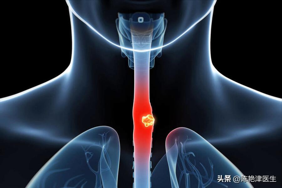 咽炎查出食管癌,以为是慢性咽炎却是食管癌