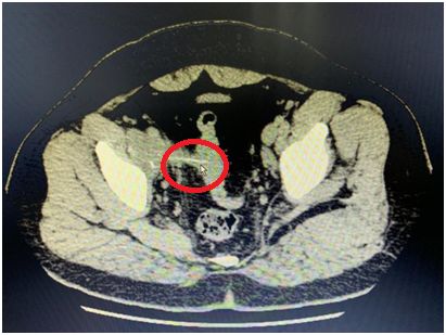 误吞牙签怎么办,少年误吞牙签一个小妙招