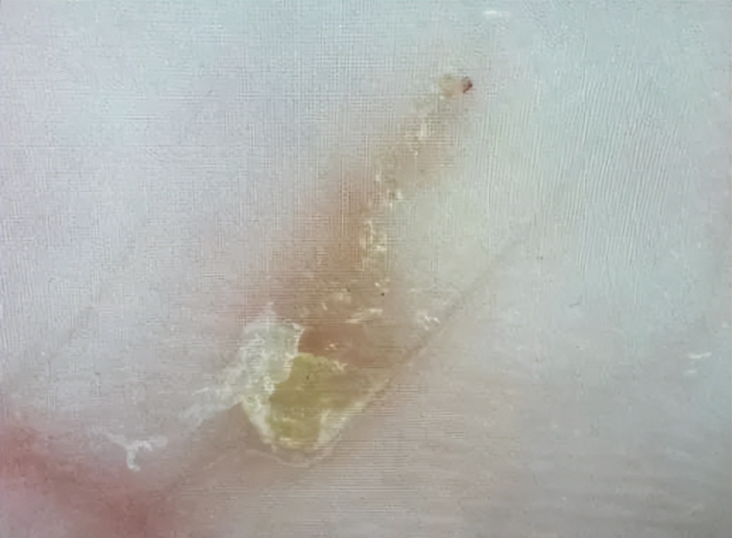 孩子全身痒痒夜间更明显怎么回事,小孩得疥疮为什么抓痒会起一个包