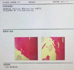 双胞胎隔“宫”相望，医生“攘外安内”