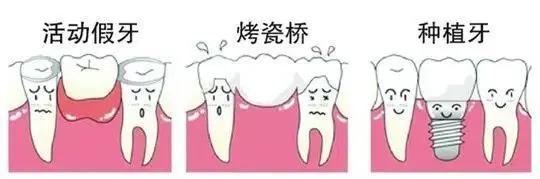 镶牙跟种植牙哪个比较好,种植牙真的比镶牙更好吗