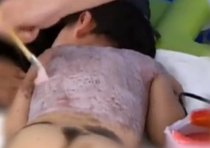 河北女子割皮救父,河北行唐母亲割皮救儿子