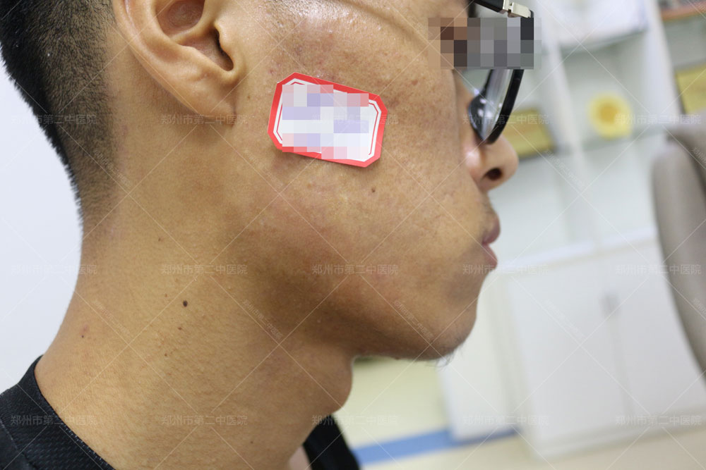 中医怎样治疗增生性疤痕疙瘩,长沙疤痕疙瘩去哪里治