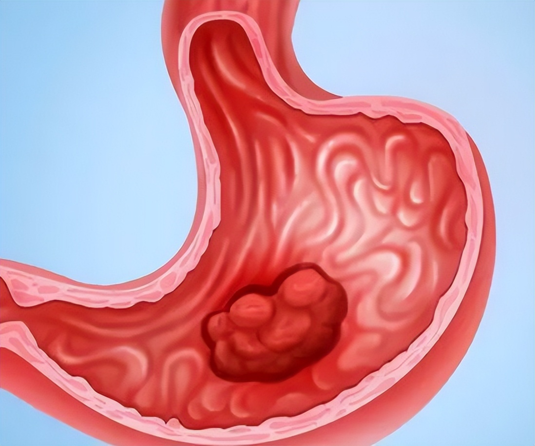 胃癌中晚期恶性肿瘤怎么治疗好,恶性程度低的胃癌