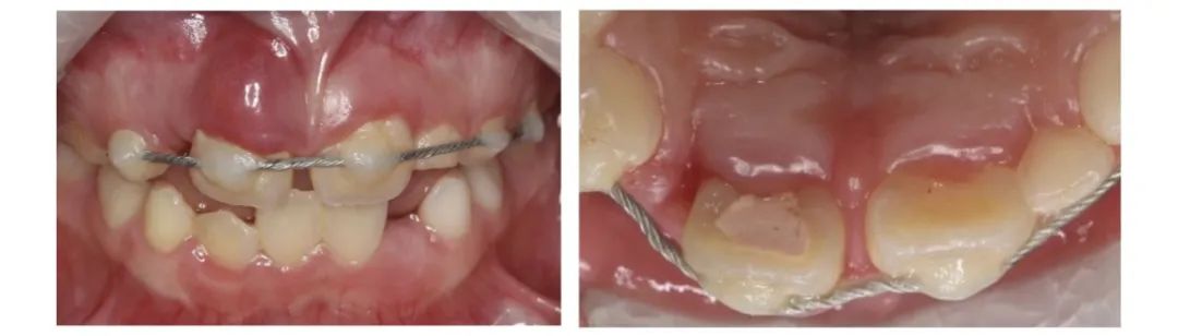 18岁大门牙断牙修复最佳方法,大门牙缺了牙髓没了