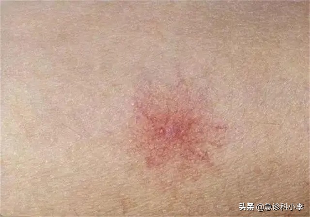 孩子身上小红点不痛不痒是什么病,身上起小红点不痛不痒按压会消失