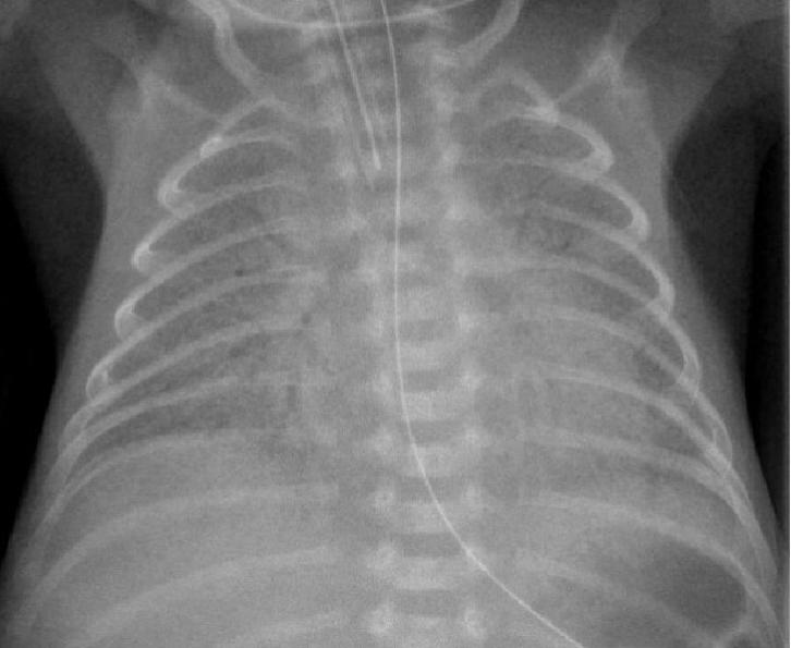 刚出生的小孩呼吸困难是怎么回事,小孩刚刚出生呼吸急促