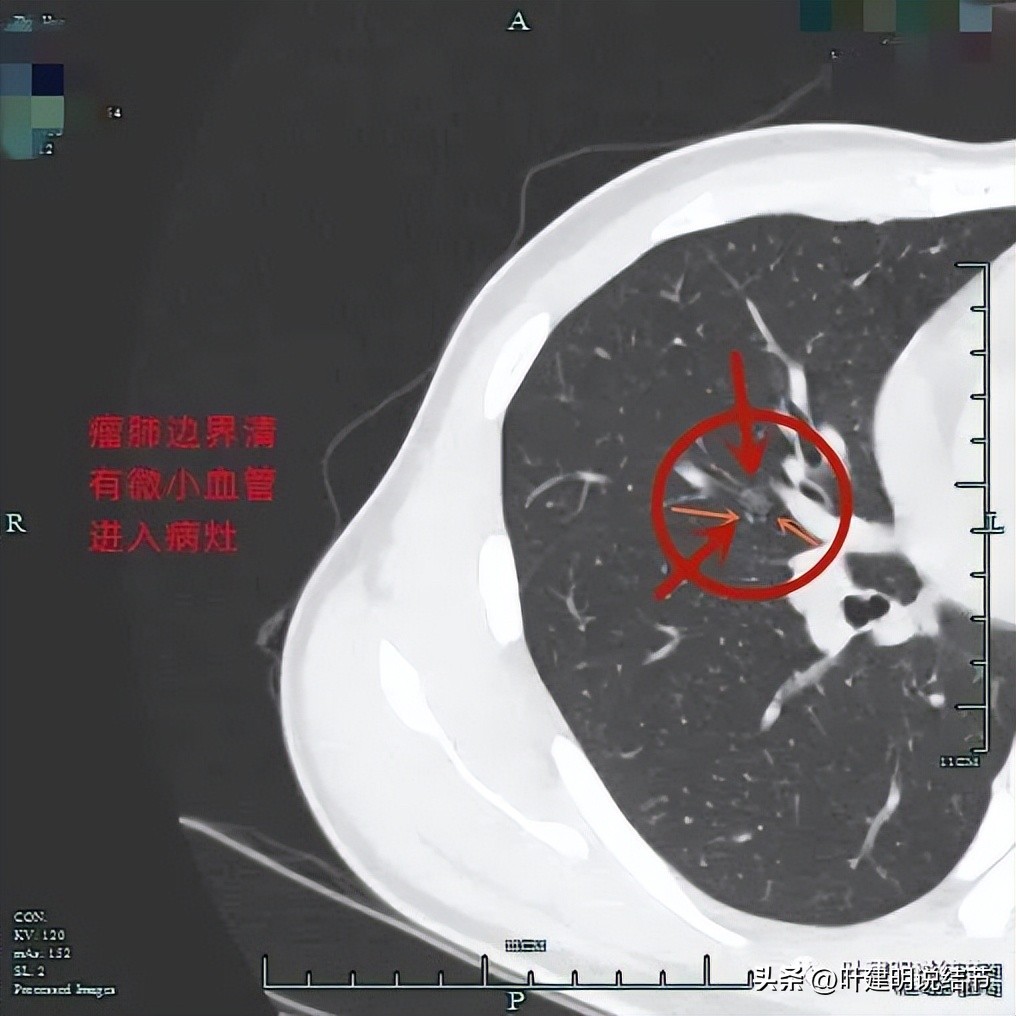 中叶多发微小结节,男性30岁右侧甲状腺单发结节