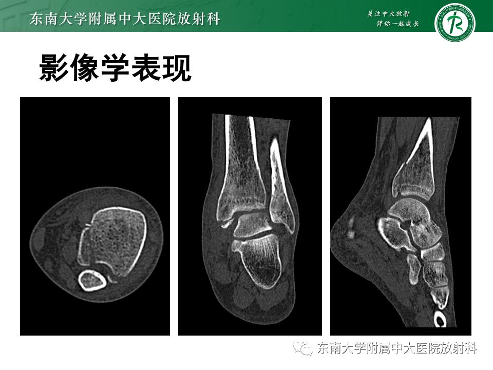 左腓骨下段骨折伴下胫腓联合分离,好文分享深度揭秘