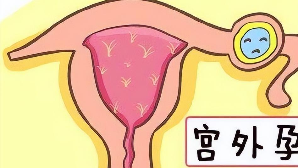 宫外孕都是有什么状况,宫外孕严重吗会有什么样的反应