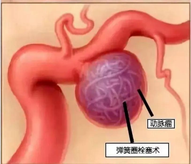不明原因的眼皮耷拉下垂,可能是这个可怕的病