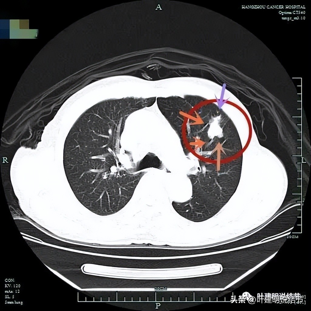 成立肺癌诊疗一体化中心,构建肺癌精准诊疗生态圈