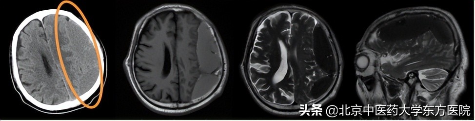 老年人慢性硬膜下血肿,老年性慢性硬膜下血肿的注意事项