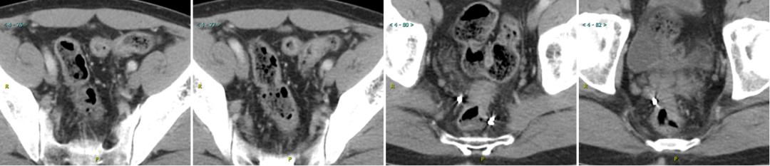 多原发癌症转移,多原发直肠癌