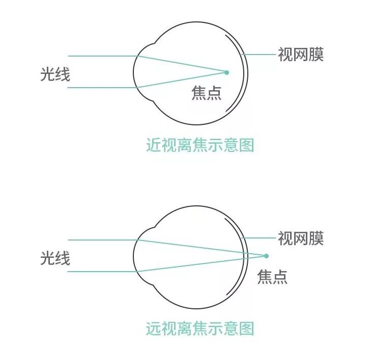 角膜塑形镜控制度数的原理是什么,角膜塑形镜控制近视度数增长