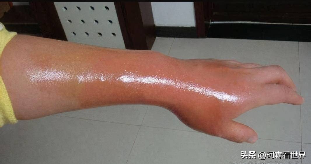 烫伤感染怎么处理,孩子在学校被同学烫伤怎么处理