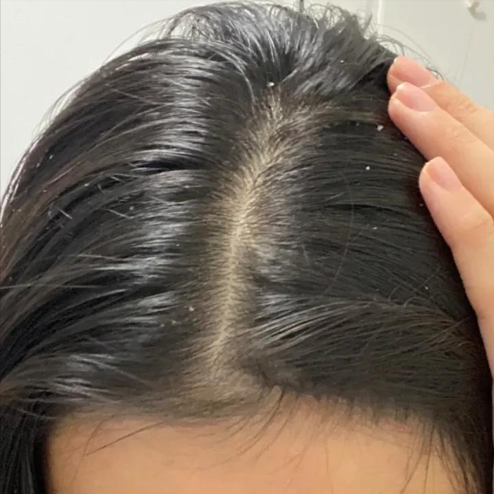 冬天头皮屑多和脸脱皮解决小妙招,冬天洗完头头皮上一层白色头皮屑