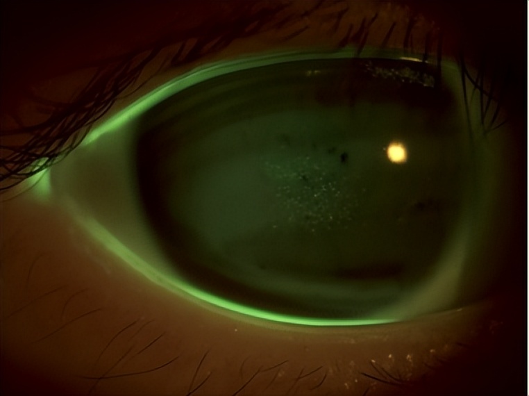 角膜接触镜验配案例图解,戴角膜塑形镜反复出现点染的原因