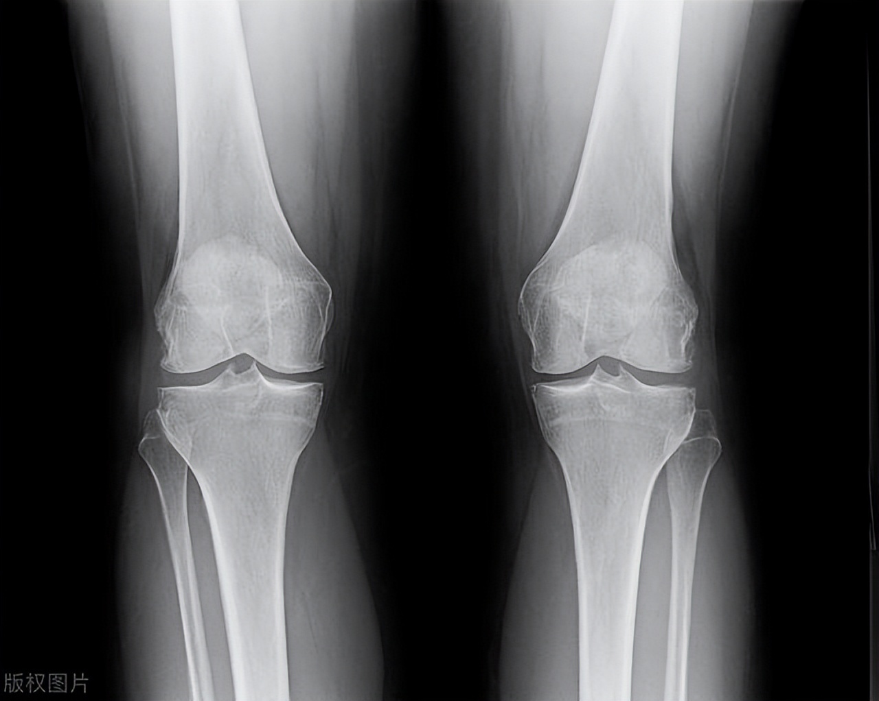 骨刺形成的原因和治疗方法,骨刺是怎样的