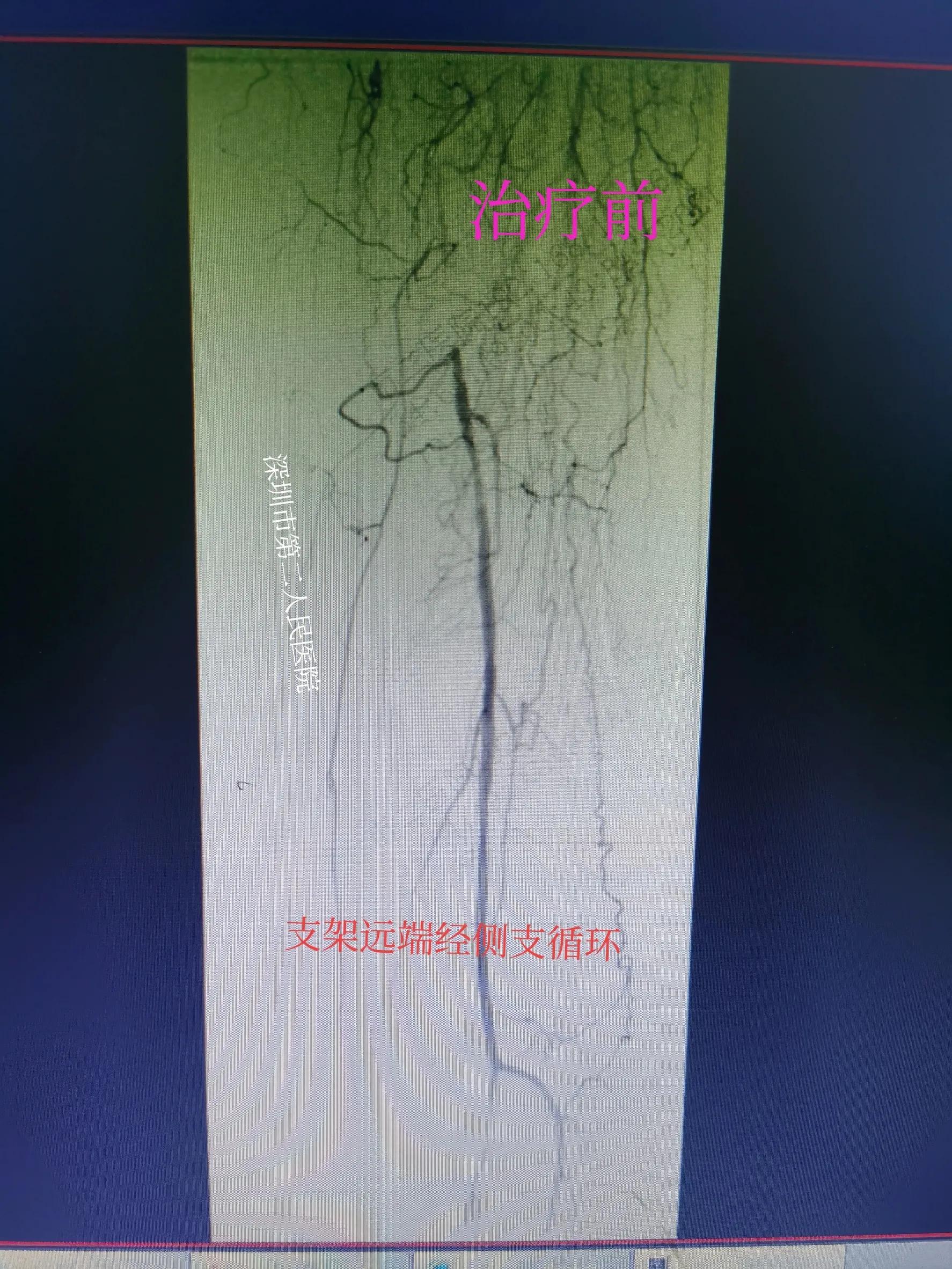 老年人小腿浮肿发紫什么原因,老人突然小腿发凉发软