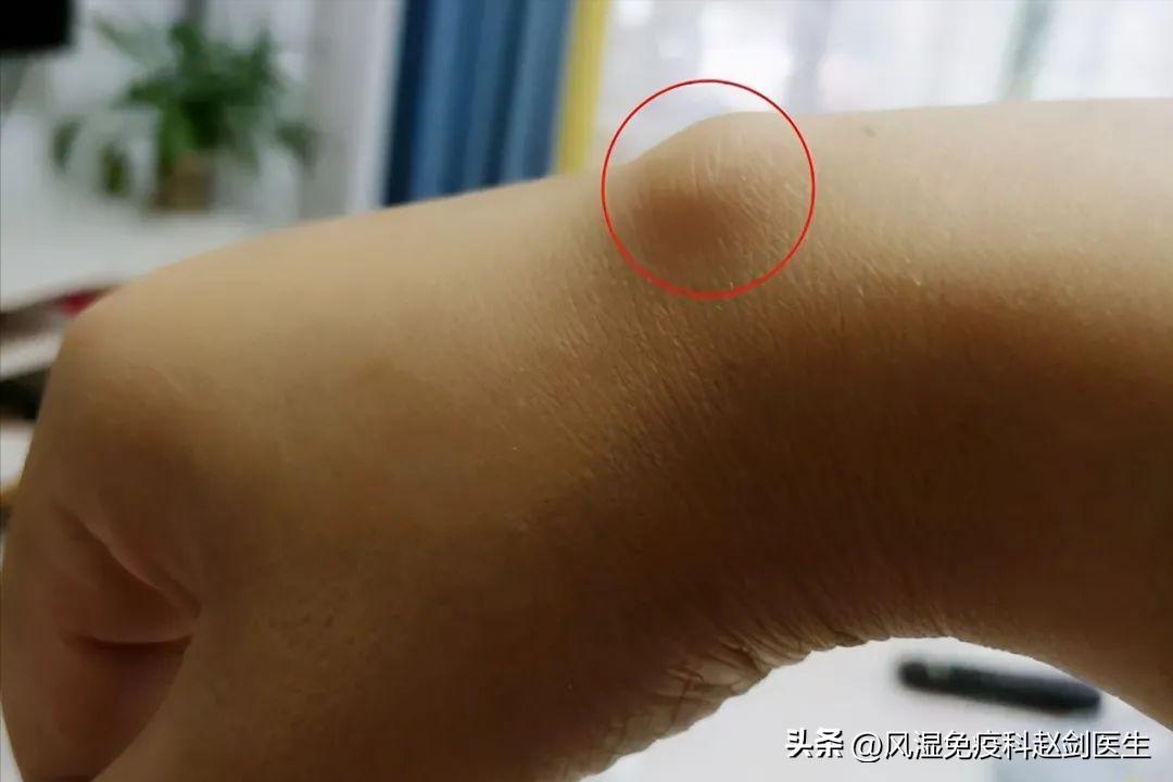 钓鱼造成手腕腱鞘炎,钓鱼导致手腕腱鞘炎