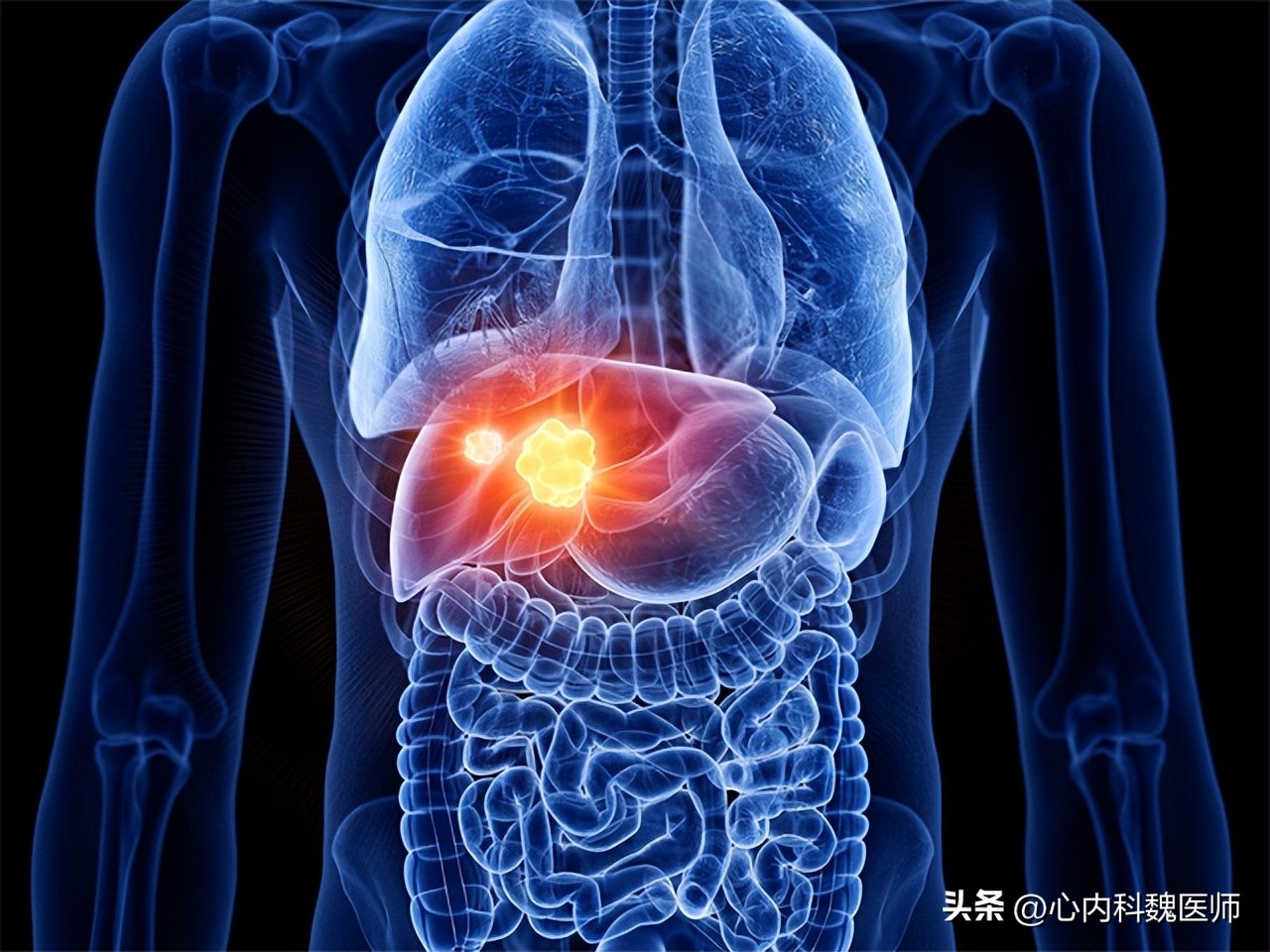 钇90微球疗法肝癌效果,钇90树脂微球治疗肝癌手术费用