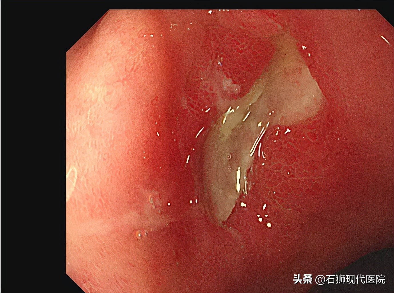 有哪些人不合适做胃镜,石狮市医院做胃镜肠镜技术可以吗