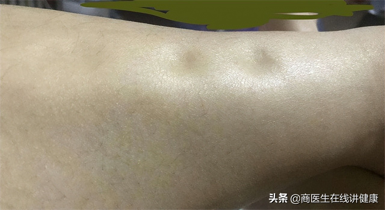 62岁男子因血糖过高死亡,弘一法师晚年得了糖尿病