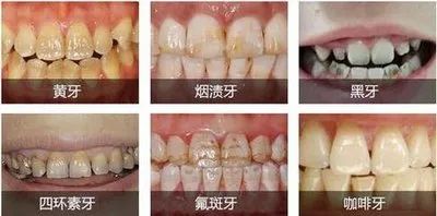 全瓷牙和烤瓷牙哪个质量好一点,全瓷牙和烤瓷牙的图片对比
