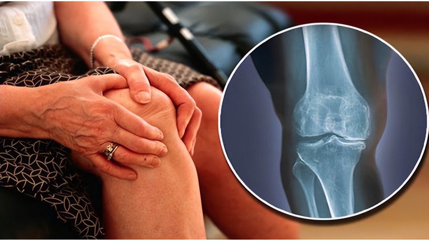 中老年膝盖半月板损伤的治疗方法,65岁老人半月板损伤膝盖痛