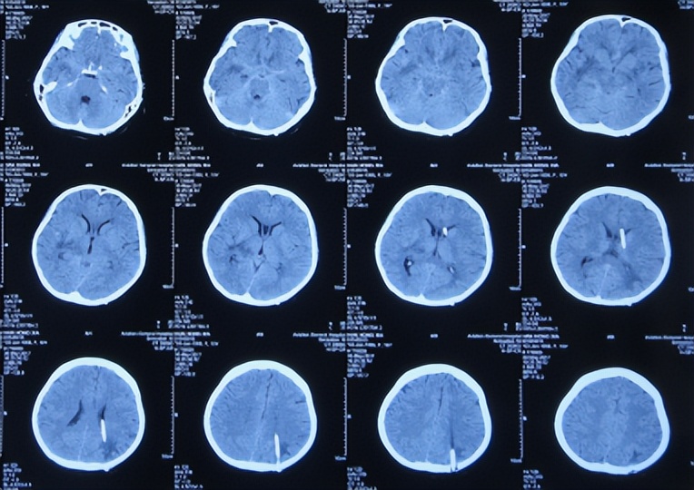 结核脑炎型脑积水怎么治,结核性脑膜炎2期很严重吗