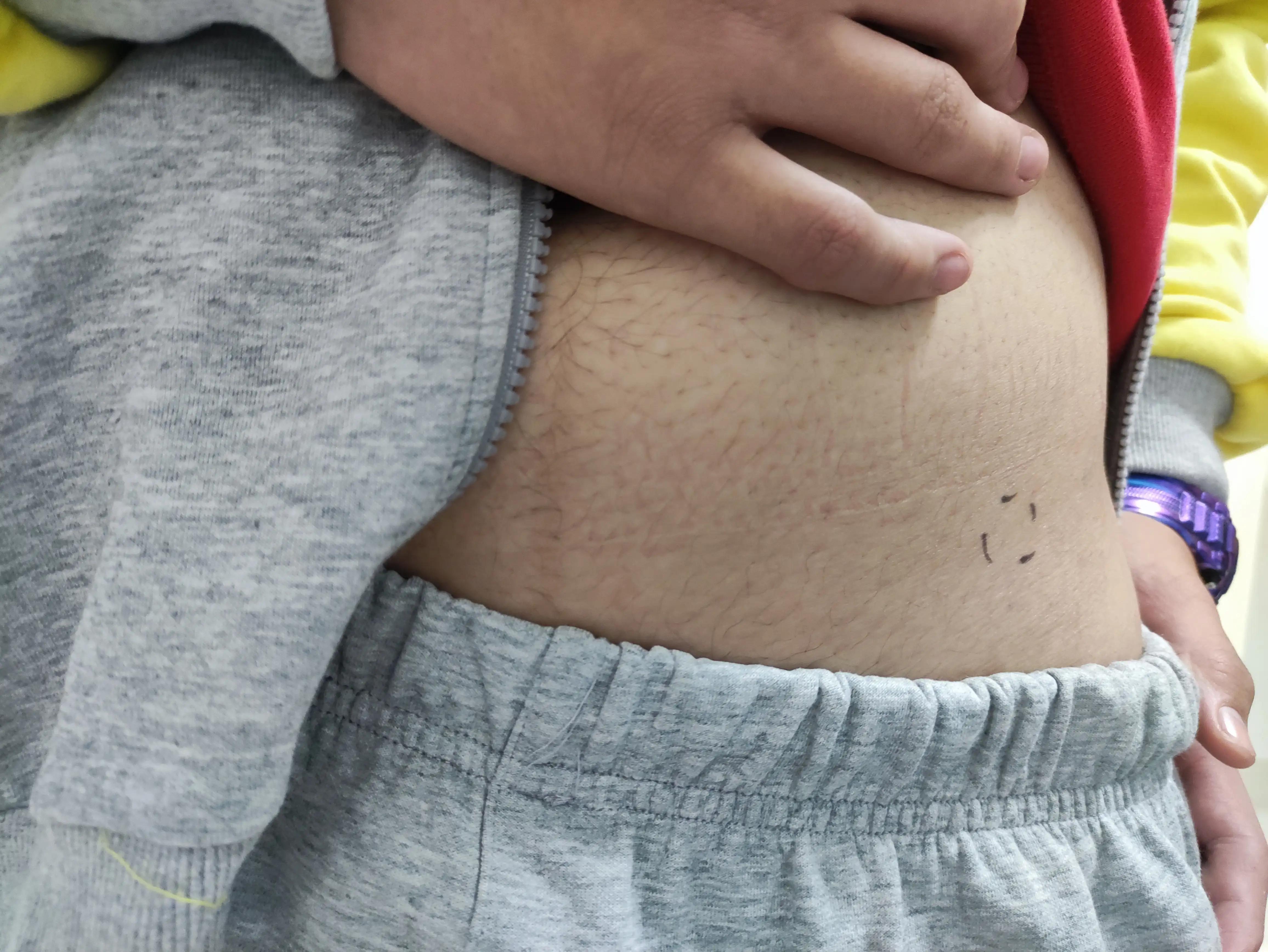 警惕｜跑完步后大腿根痛，一查竟是骨折了，青少年多见