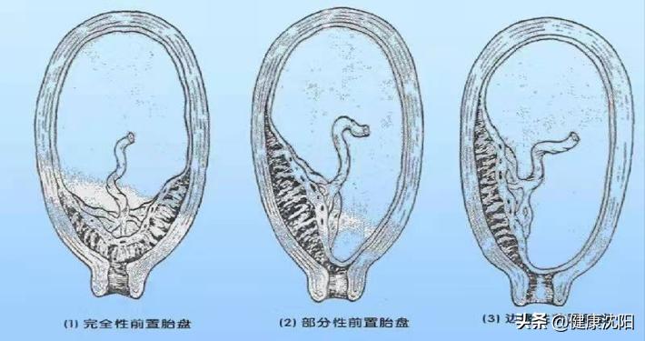 孕妇凶险性前置胎盘怎么办,前置胎盘是妊娠并发症吗