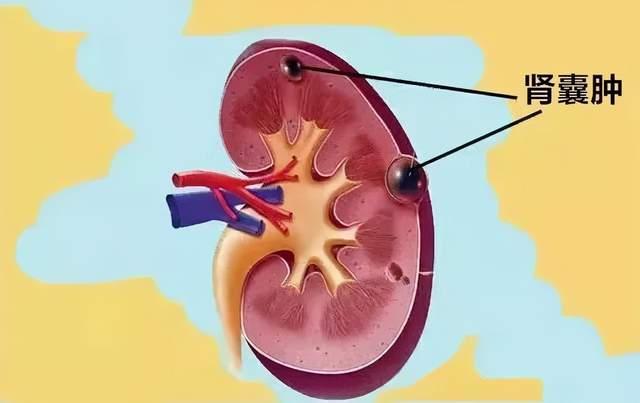 发现囊肿需要注意什么,医生提醒大多数囊肿无需处理