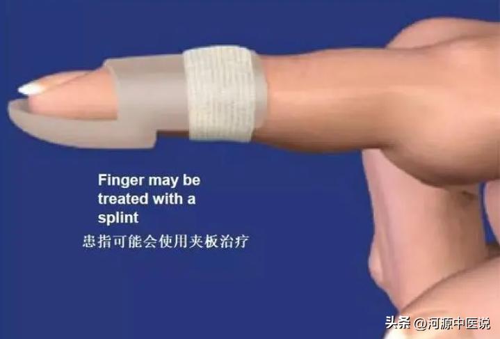 打篮球戳到手指后的治疗方法,打篮球戳到手肿胀怎么回复