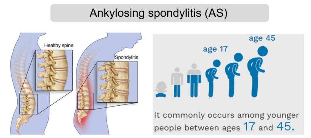 治疗强直性脊柱炎必须按体质治吗,针对强直性脊柱炎最好的锻炼方法