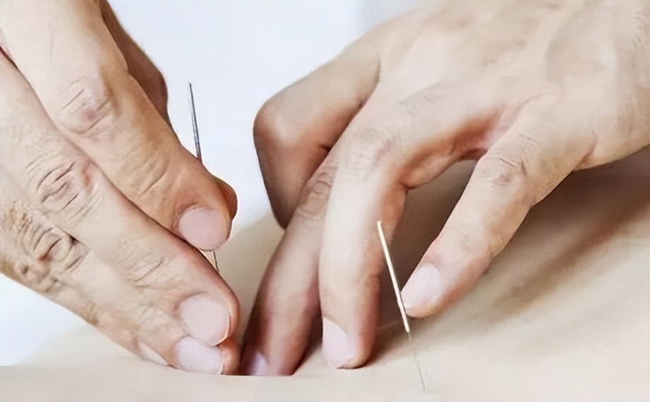 刺络拔罐联合常规针刺治疗神经根型颈椎病如何治疗?疗效如何?